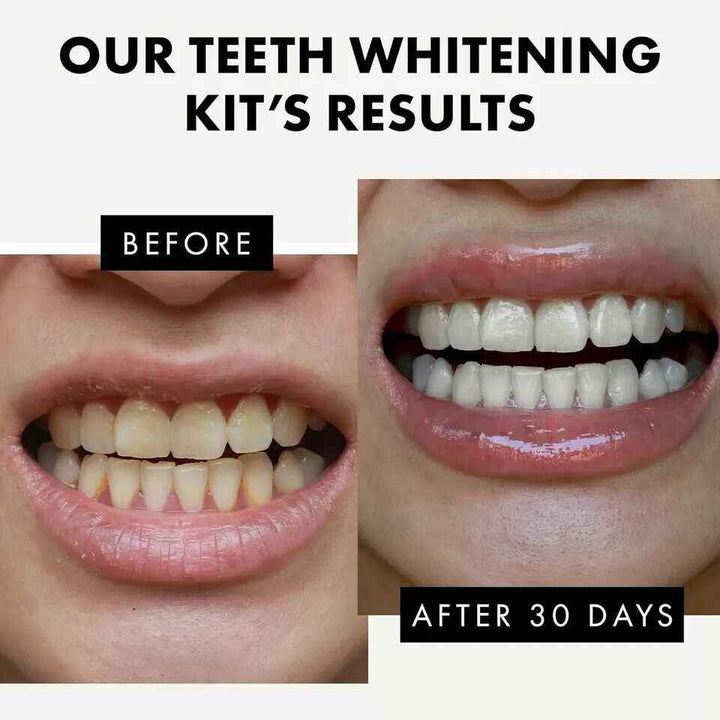 Teeth Whitening Kit