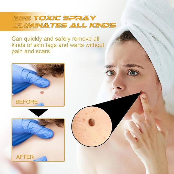 3 Pcs 20 ml Bee Venom Wart and Tag Remover, Tag Recede Bee Venom Spray - OneBag